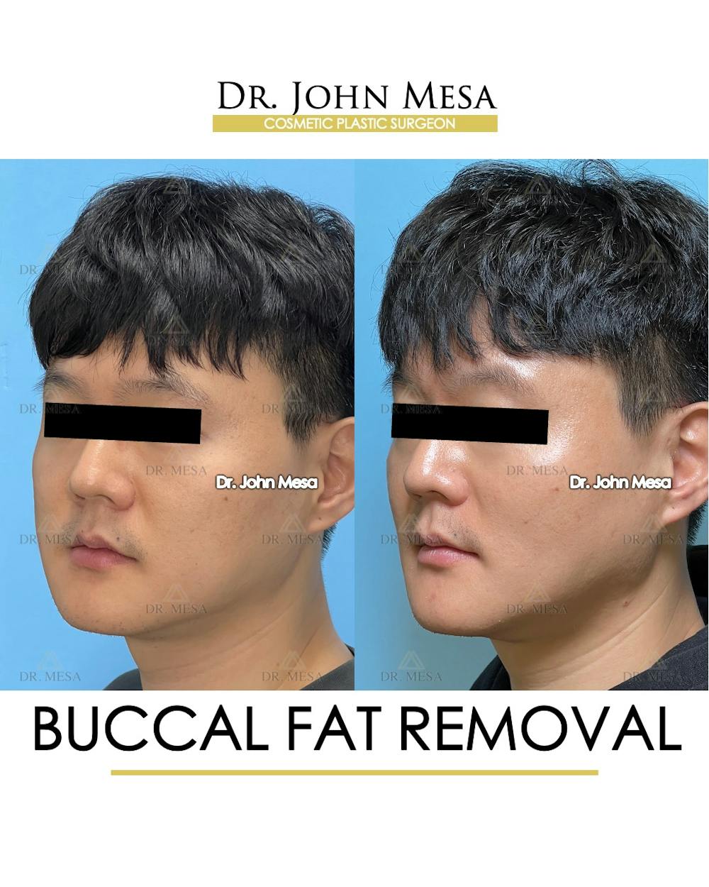 Buccal Fat Pad Removal for Men Before & After Gallery - Patient 401938 - Image 5