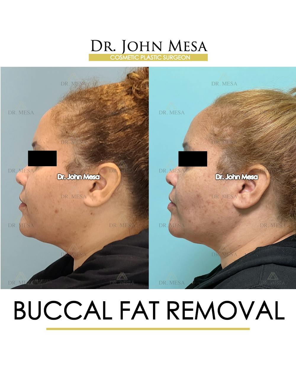 Buccal Fat Pad Removal Before & After Gallery - Patient 393589 - Image 5