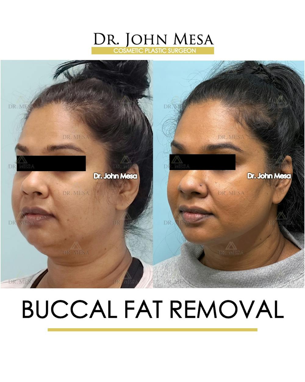 Buccal Fat Pad Removal Before & After Gallery - Patient 142715 - Image 3