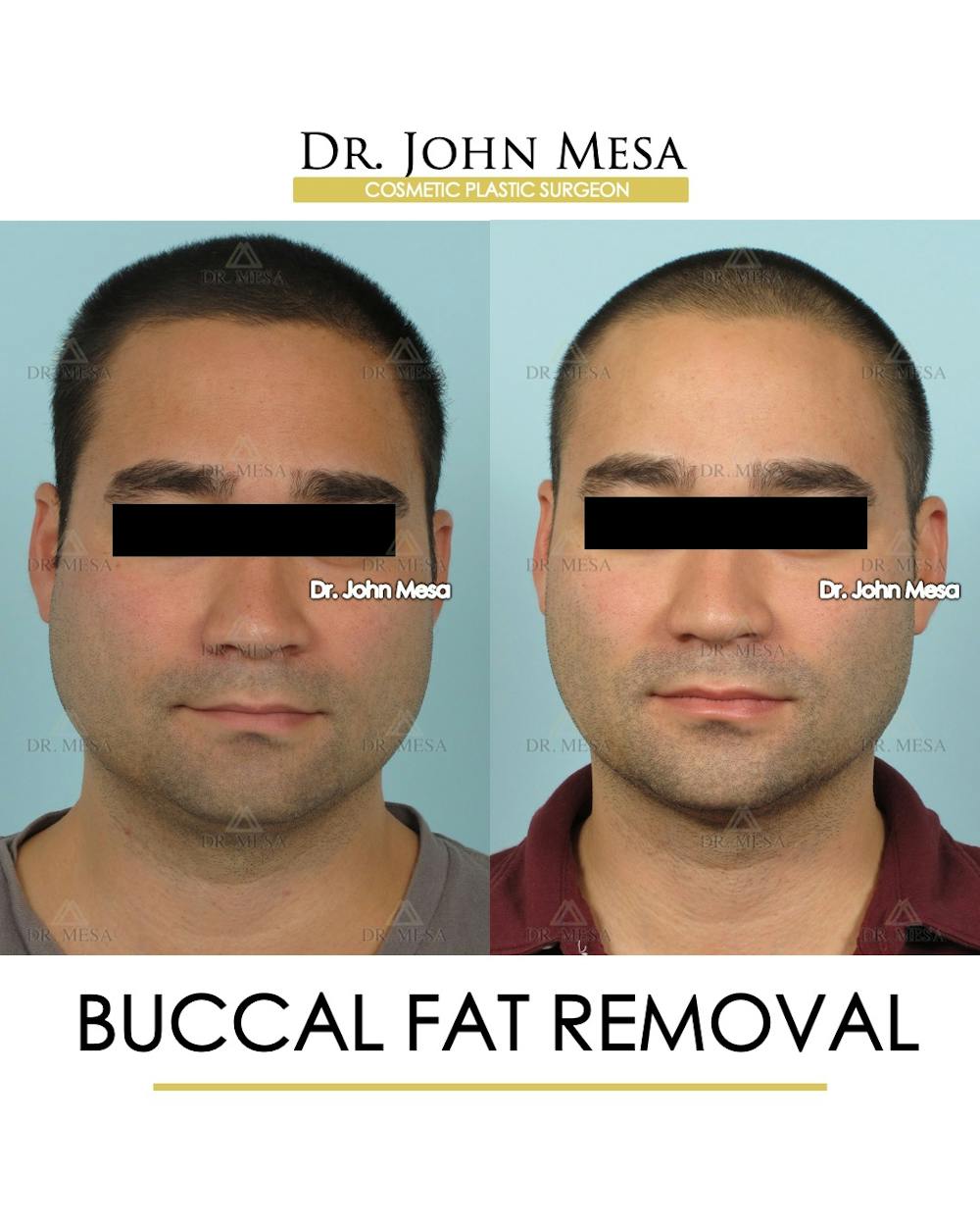 Patient 168195 Buccal Fat Pad Removal for Men Before & After Photos