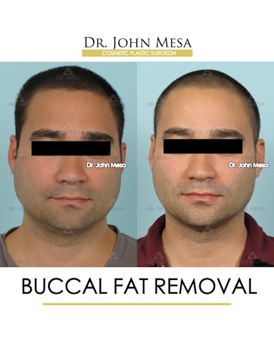 Buccal Fat Pad Removal for Men Before & After Gallery - Patient 168195 - Image 1