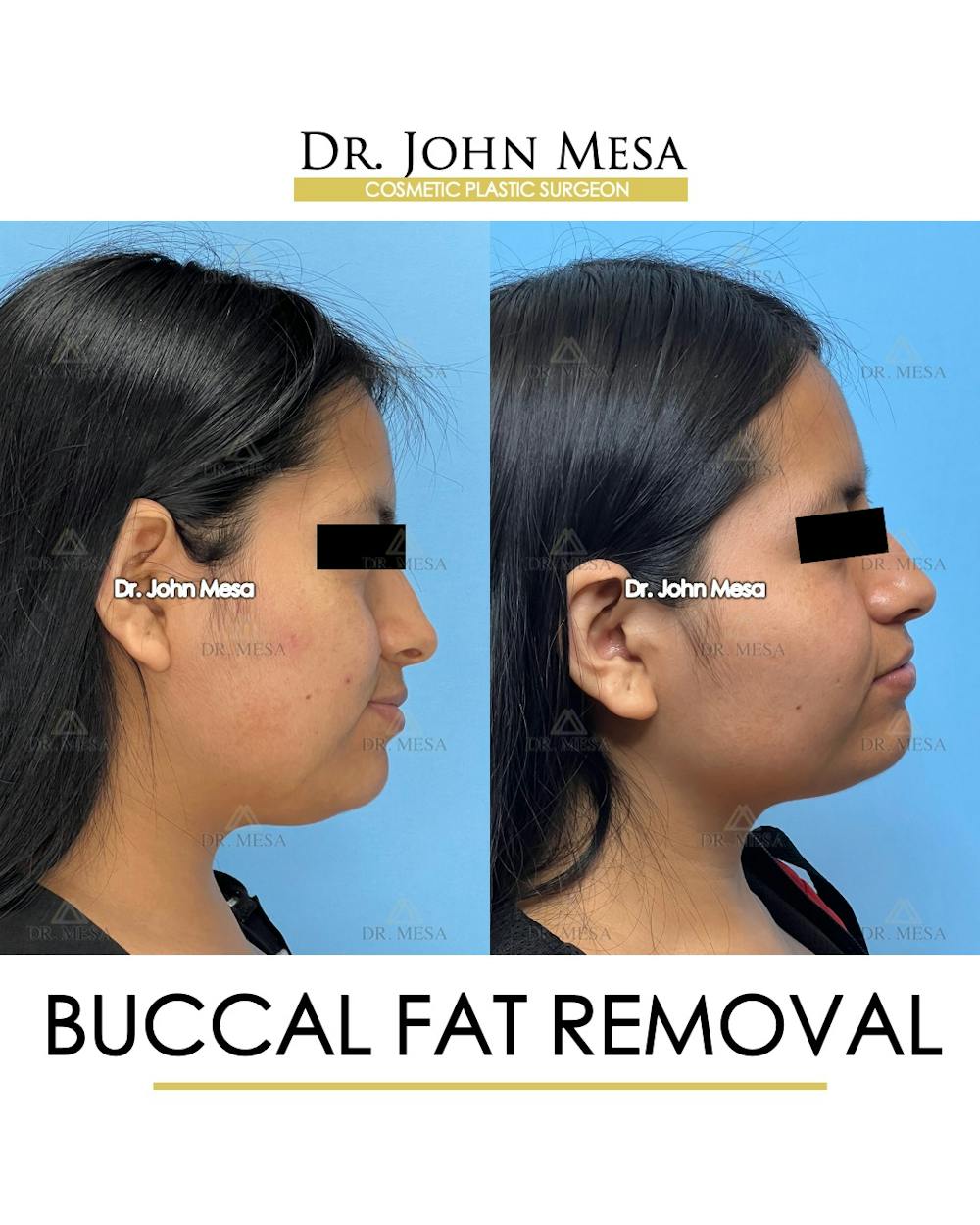 Buccal Fat Pad Removal Before & After Gallery - Patient 356525 - Image 5