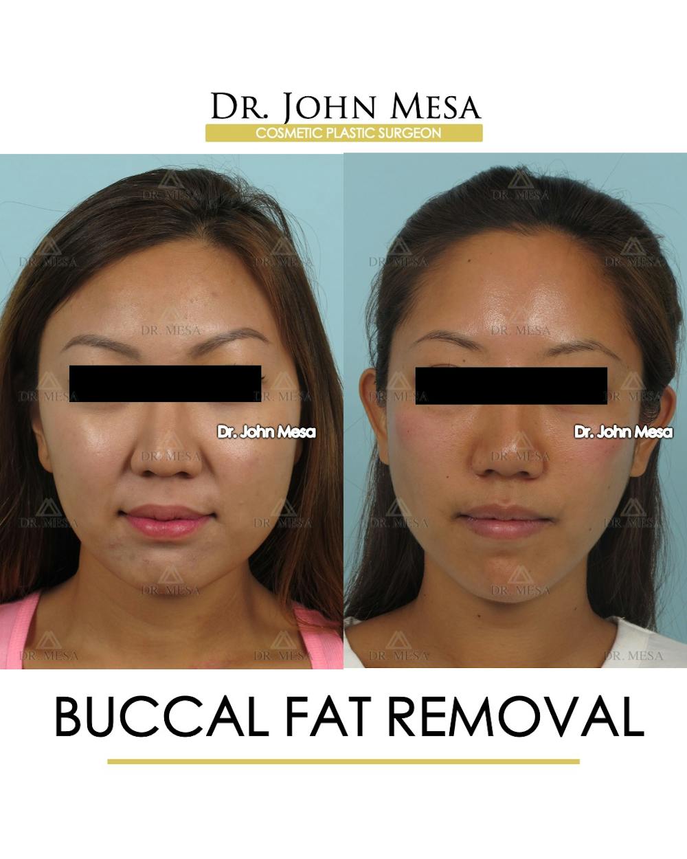 Buccal Fat Pad Removal Before & After Gallery - Patient 339169 - Image 1