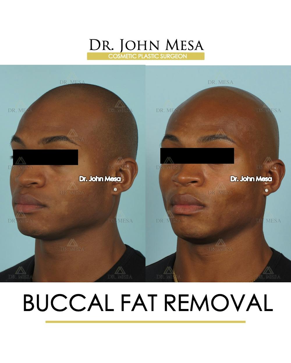 Buccal Fat Pad Removal for Men Before & After Gallery - Patient 807049 - Image 3