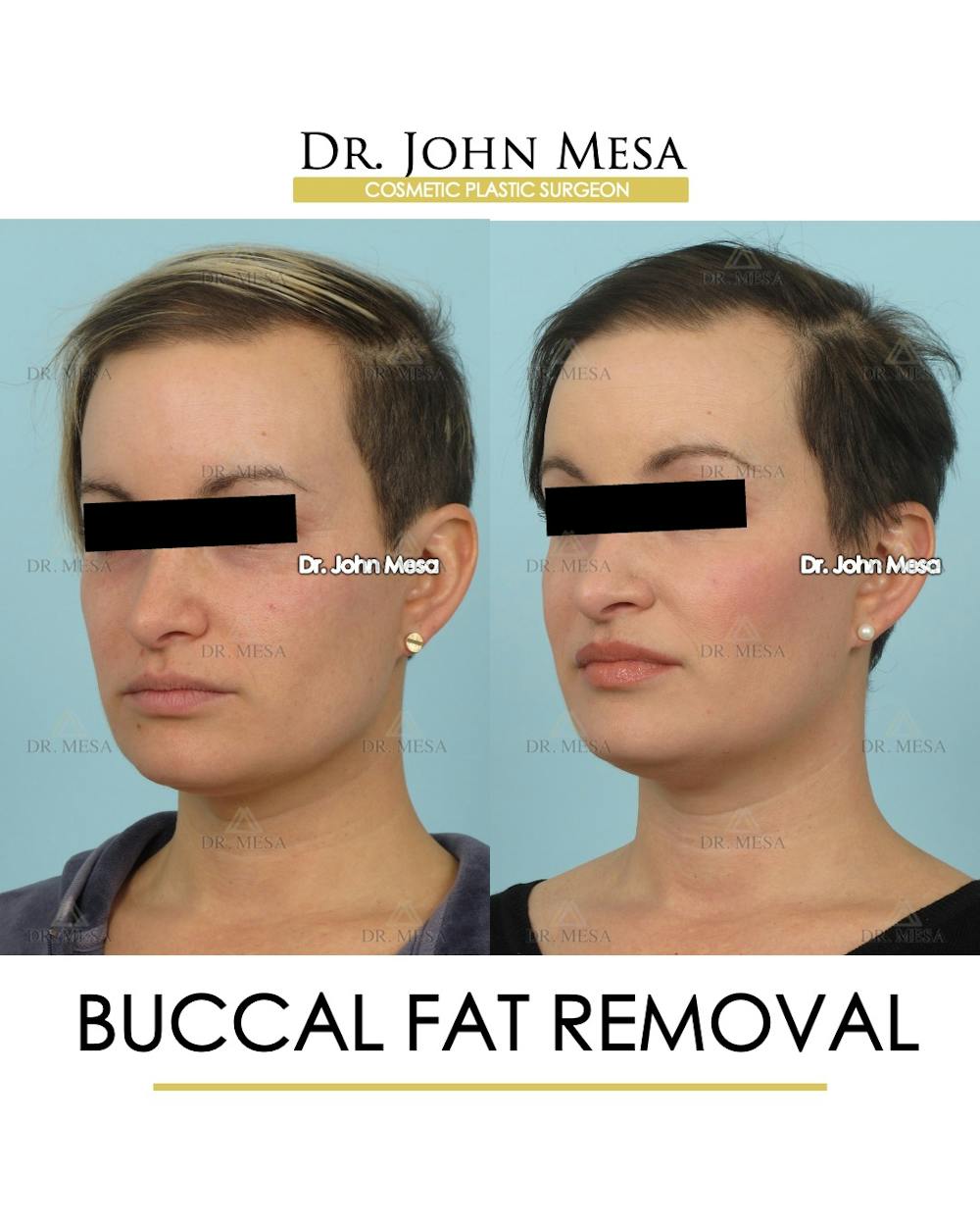 Buccal Fat Pad Removal Before & After Gallery - Patient 224881 - Image 3