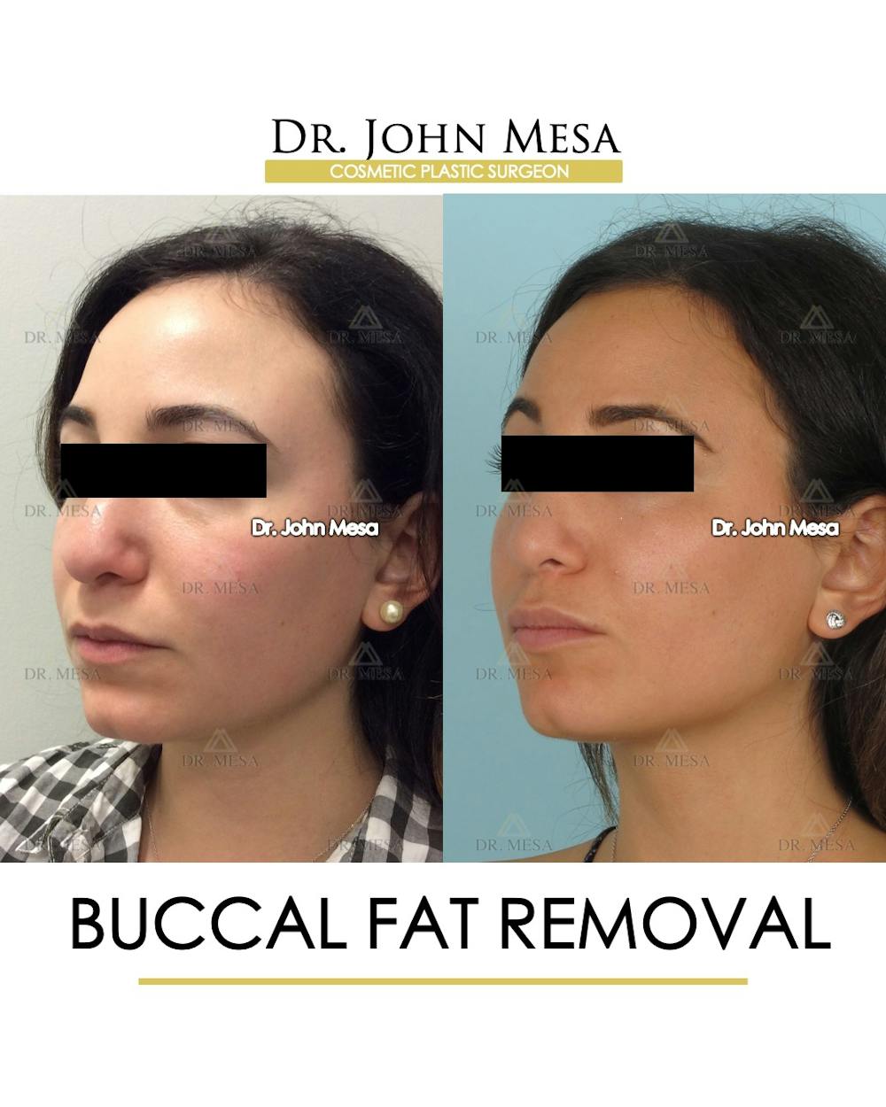 Buccal Fat Pad Removal Before & After Gallery - Patient 386848 - Image 3