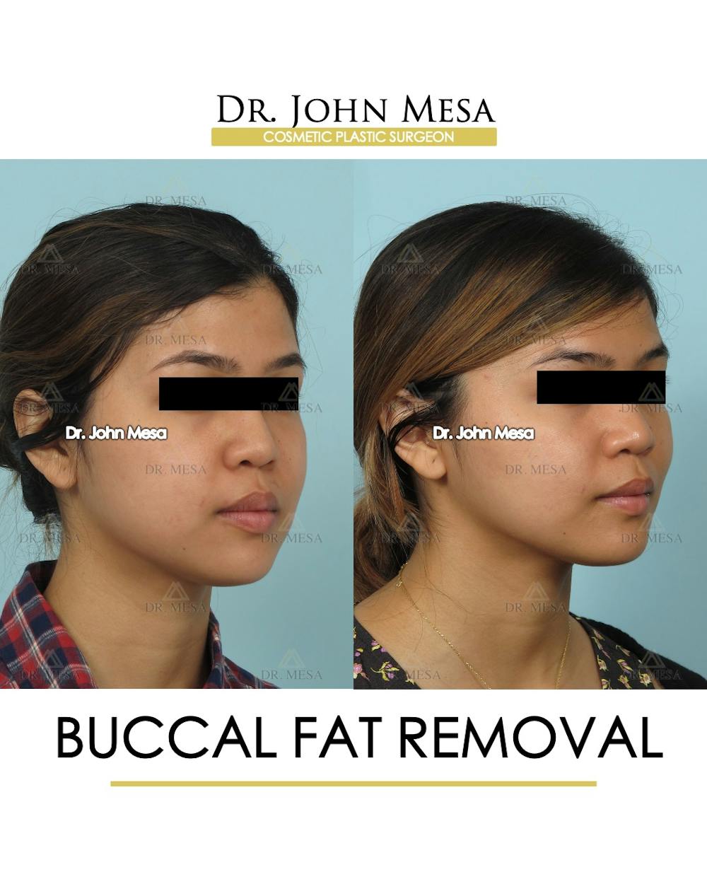 Buccal Fat Pad Removal Before & After Gallery - Patient 336067 - Image 2