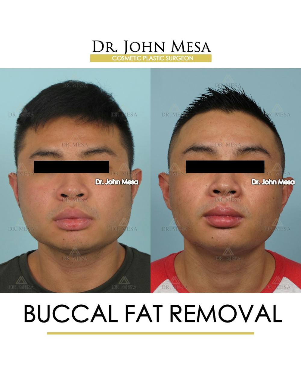 Patient 595742 Buccal Fat Pad Removal for Men Before & After Photos Dr. Mesa