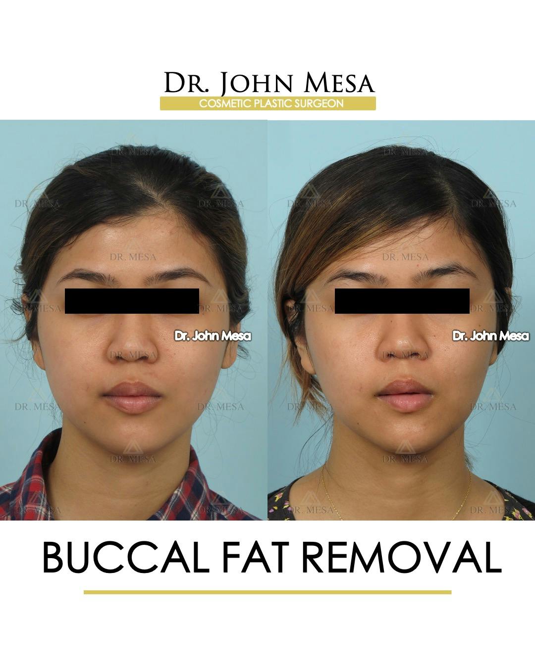 Buccal Fat Pad Removal Before & After Gallery - Patient 336067 - Image 1