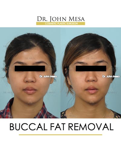 Buccal Fat Pad Removal Before & After Gallery - Patient 336067 - Image 1