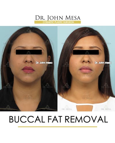 Buccal Fat Pad Removal Before & After Gallery - Patient 120558 - Image 1