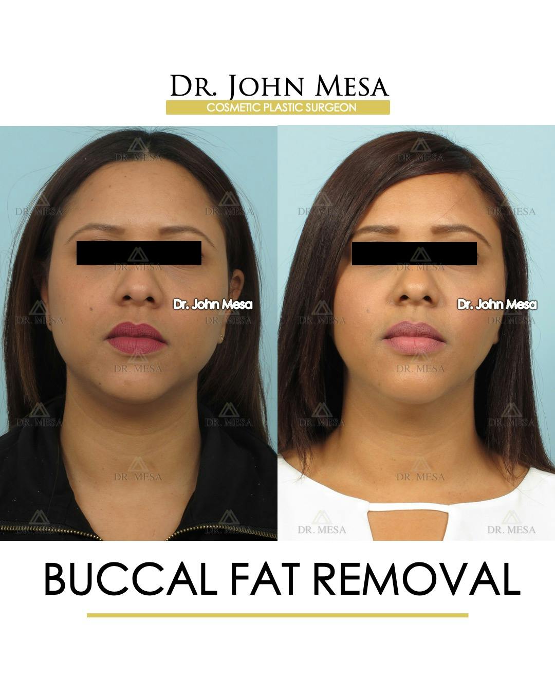 Buccal Fat Pad Removal Before & After Gallery - Patient 120558 - Image 1
