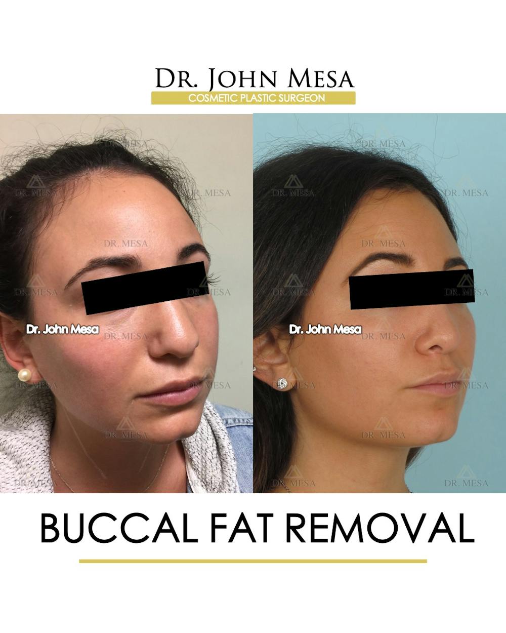 Buccal Fat Pad Removal Before & After Gallery - Patient 386848 - Image 2