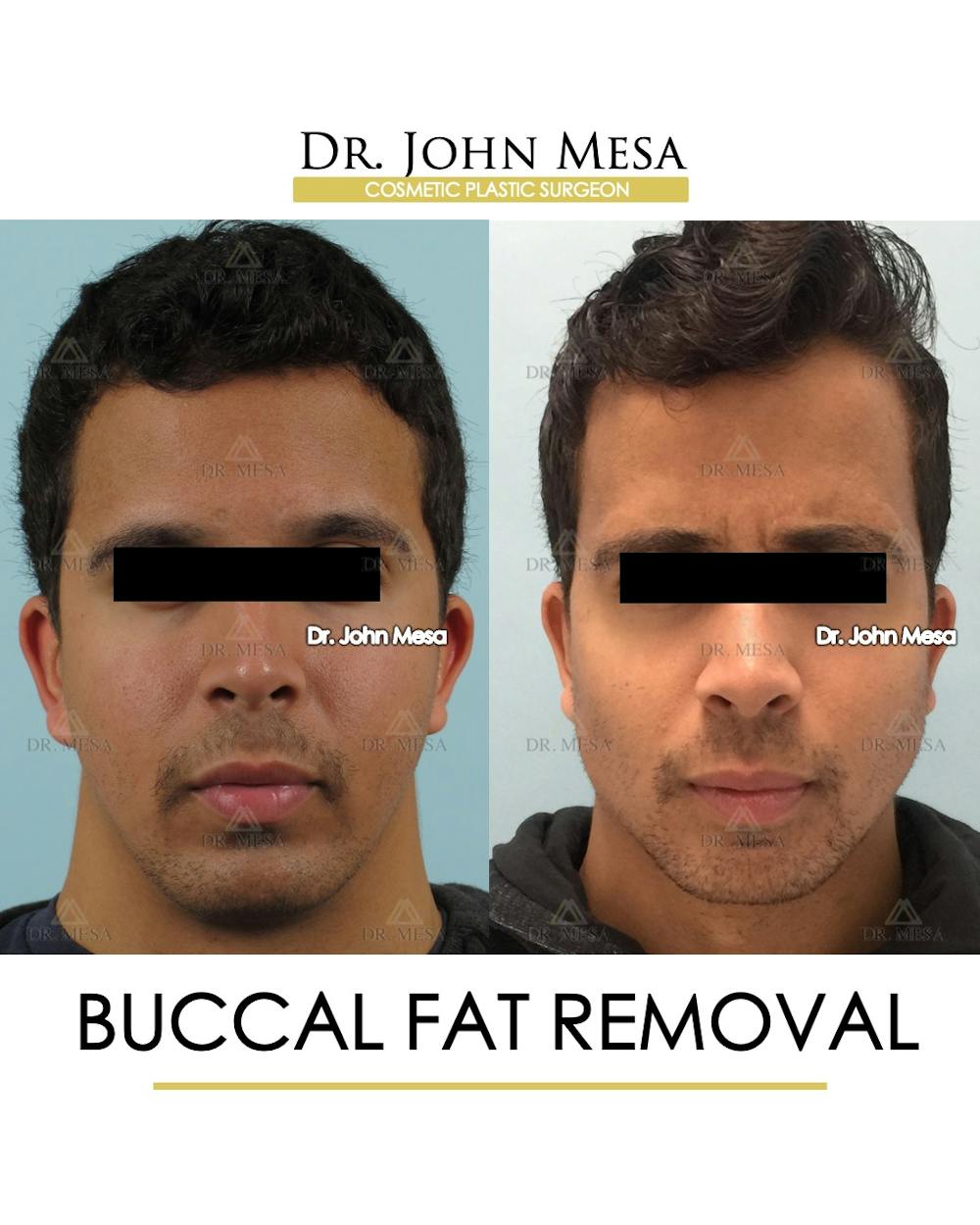 Buccal Fat Pad Removal for Men Before & After Gallery - Patient 239585 - Image 1