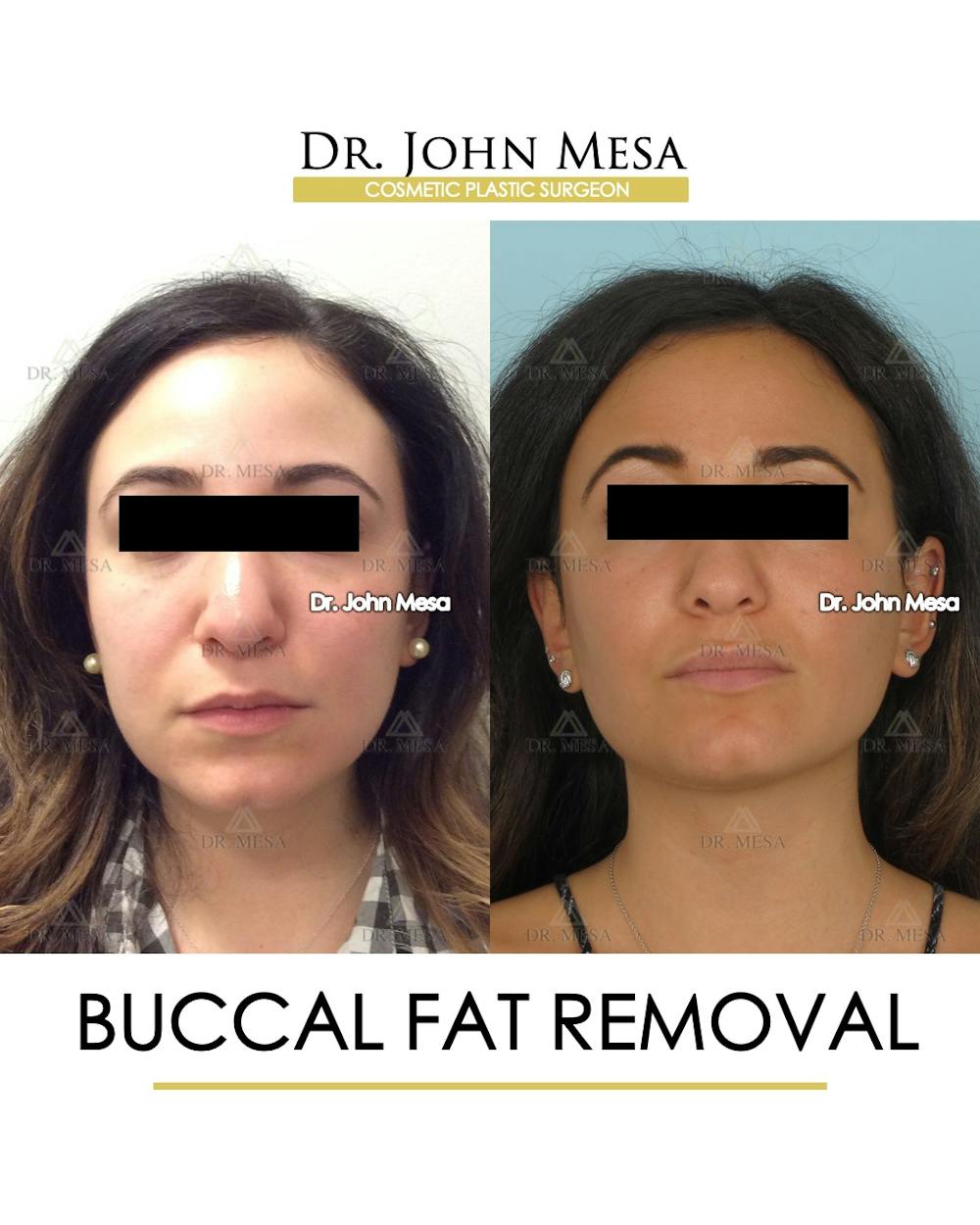 Buccal Fat Pad Removal Before & After Gallery - Patient 386848 - Image 1