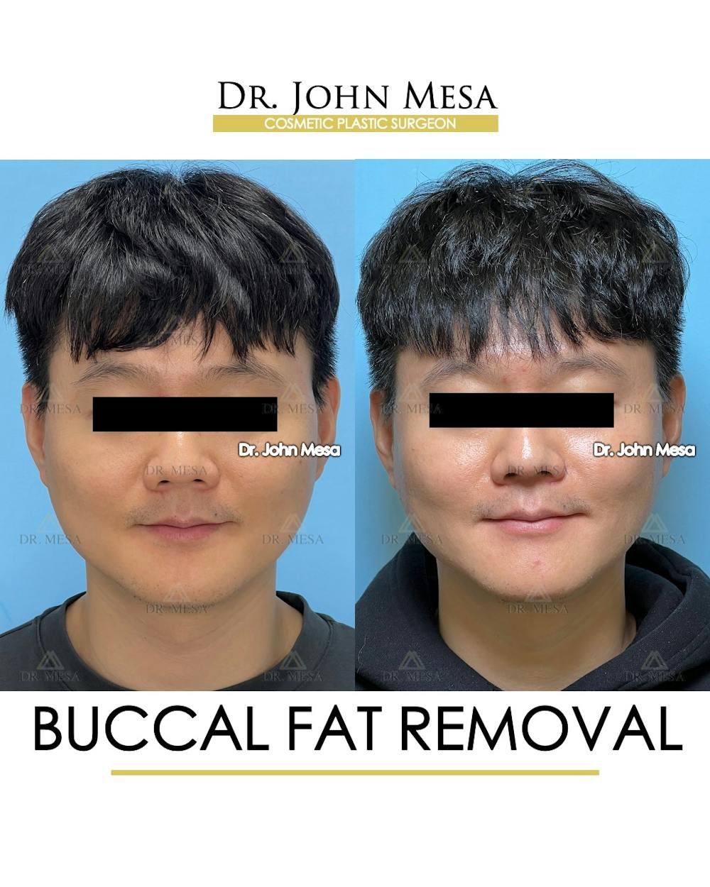 Buccal Fat Pad Removal for Men Before & After Gallery - Patient 401938 - Image 2