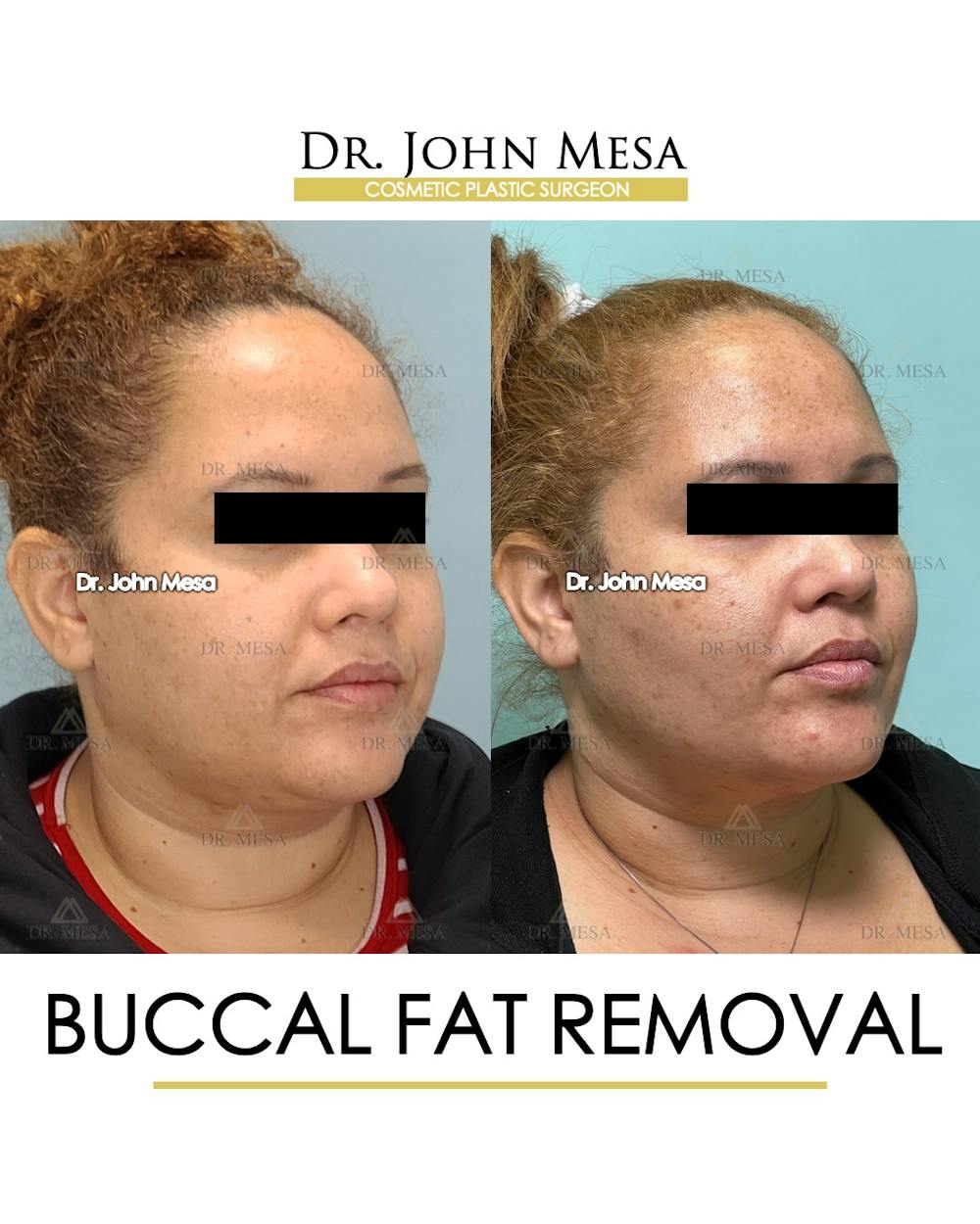 Buccal Fat Pad Removal Before & After Gallery - Patient 393589 - Image 2