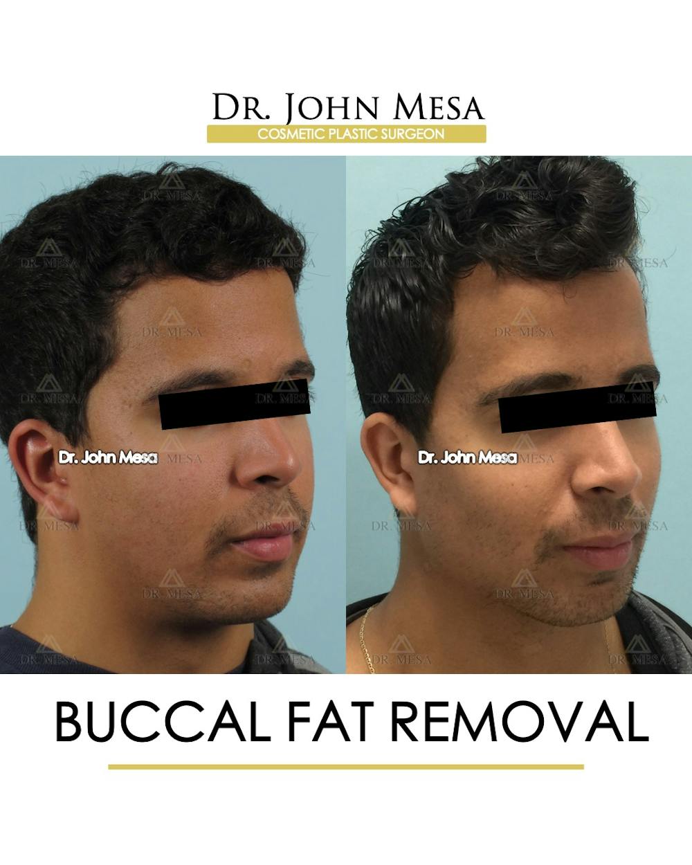 Buccal Fat Pad Removal for Men Before & After Gallery - Patient 239585 - Image 3
