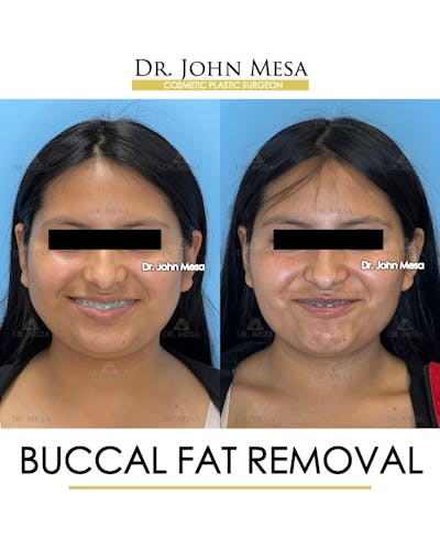 Buccal Fat Pad Removal Before & After Gallery - Patient 356525 - Image 2