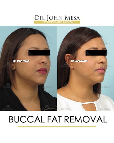 Buccal Fat Pad Removal Before & After Gallery - Patient 120558 - Image 2