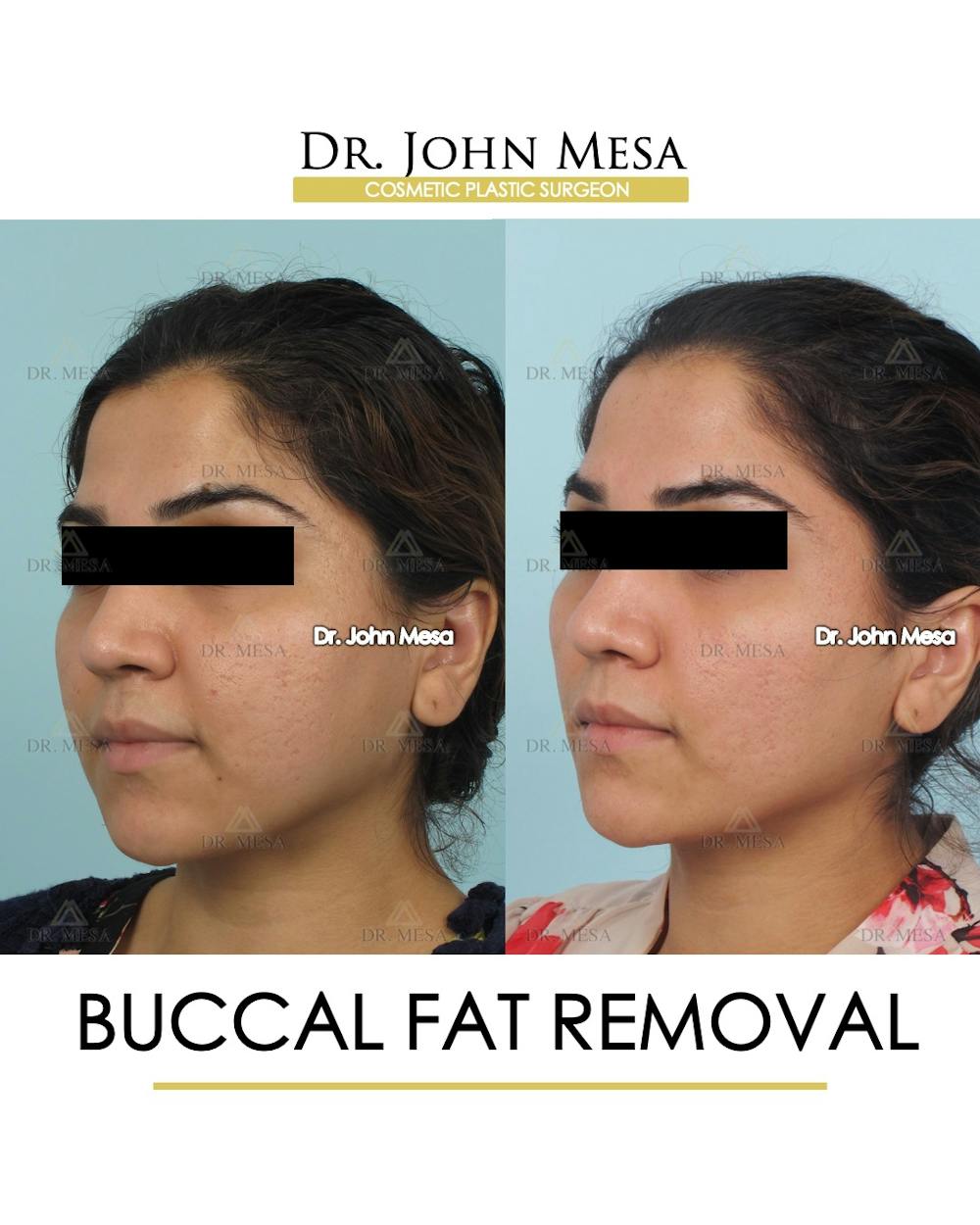 Buccal Fat Pad Removal Before & After Gallery - Patient 308898 - Image 3