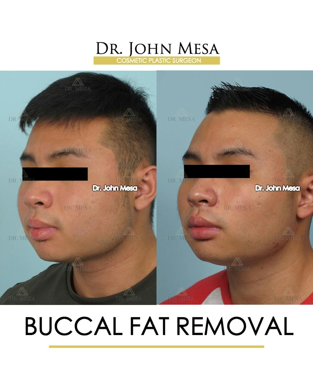 Buccal Fat Pad Removal for Men Before & After Gallery - Patient 595742 - Image 3