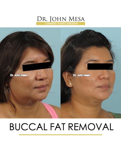 Buccal Fat Pad Removal Before & After Gallery - Patient 206282 - Image 2