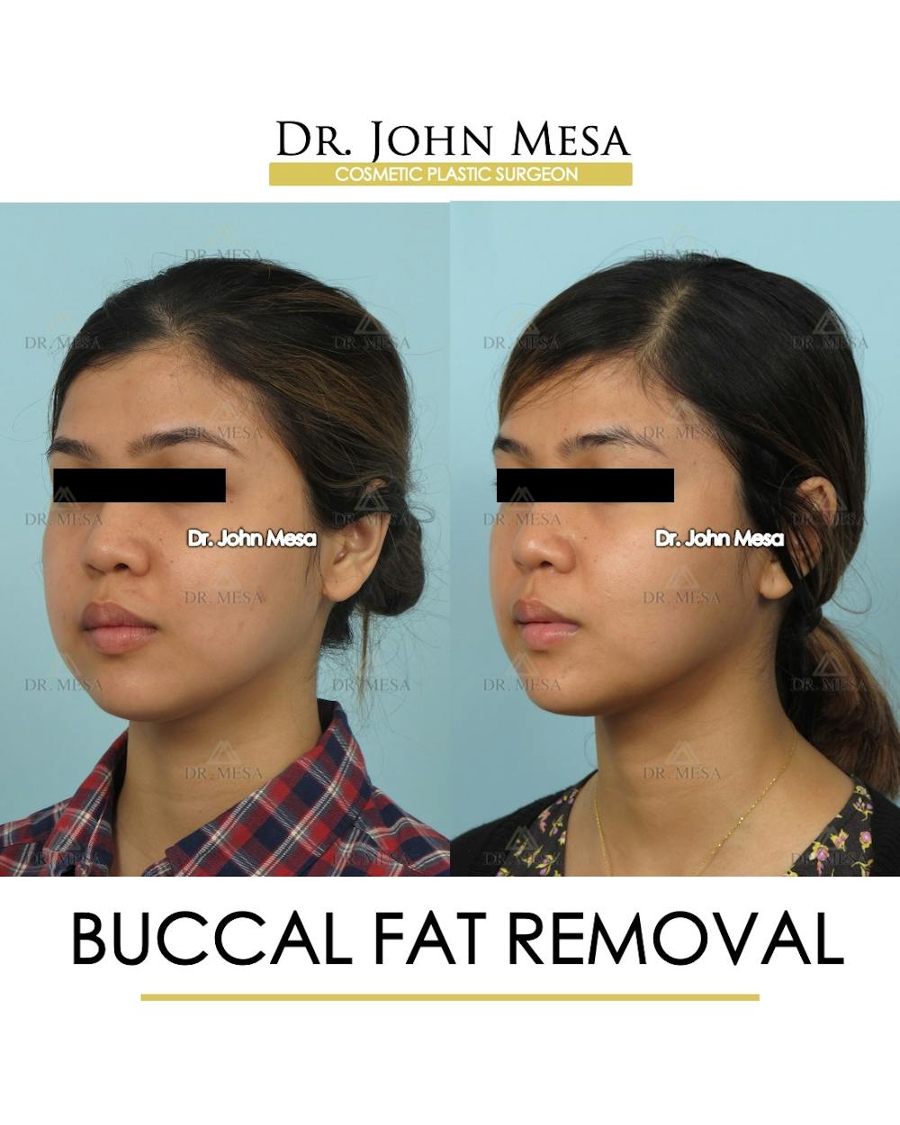 Buccal Fat Pad Removal Before & After Gallery - Patient 336067 - Image 3
