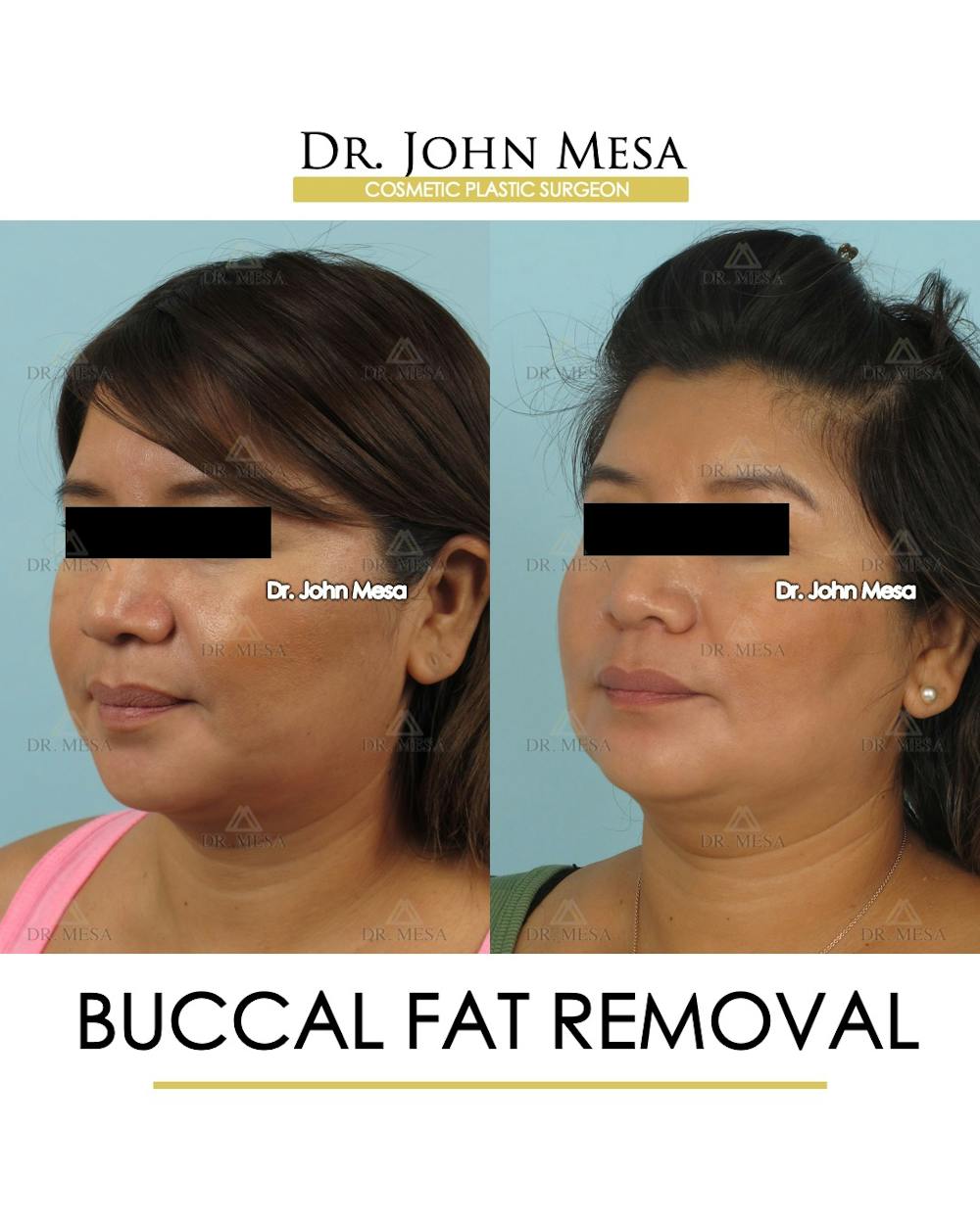 Buccal Fat Pad Removal Before & After Gallery - Patient 206282 - Image 3