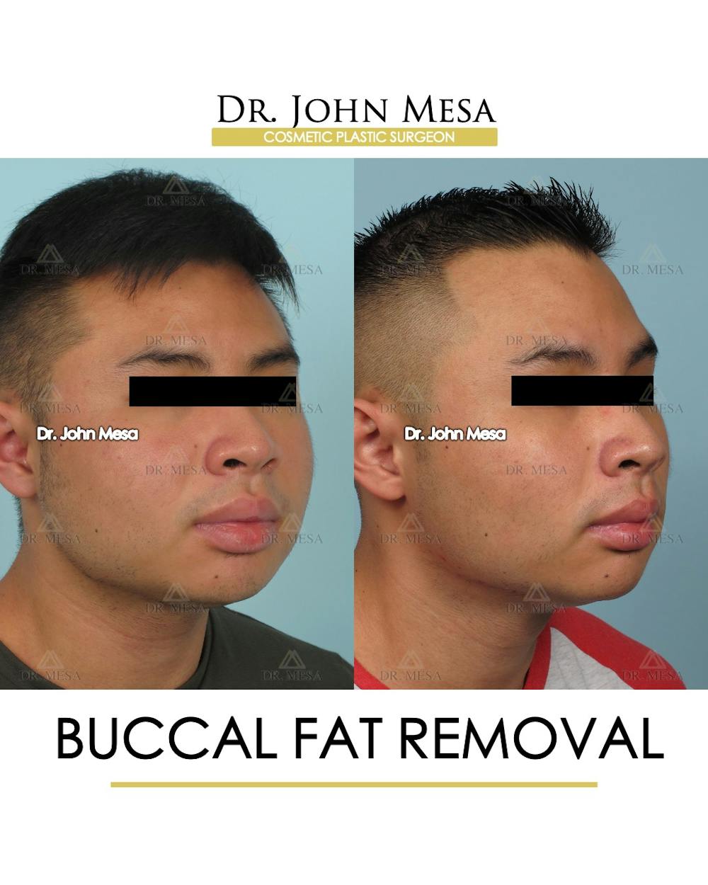 Buccal Fat Pad Removal for Men Before & After Gallery - Patient 595742 - Image 2
