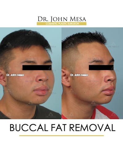Buccal Fat Pad Removal for Men Before & After Gallery - Patient 595742 - Image 2
