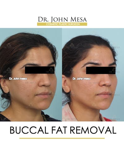 Buccal Fat Pad Removal Before & After Gallery - Patient 308898 - Image 2