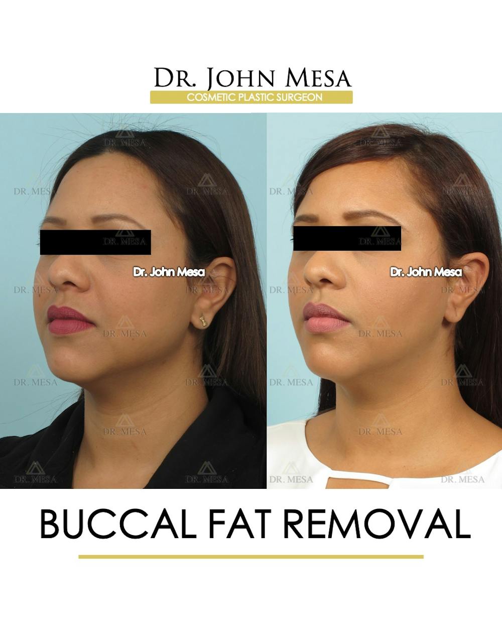 Buccal Fat Pad Removal Before & After Gallery - Patient 120558 - Image 3