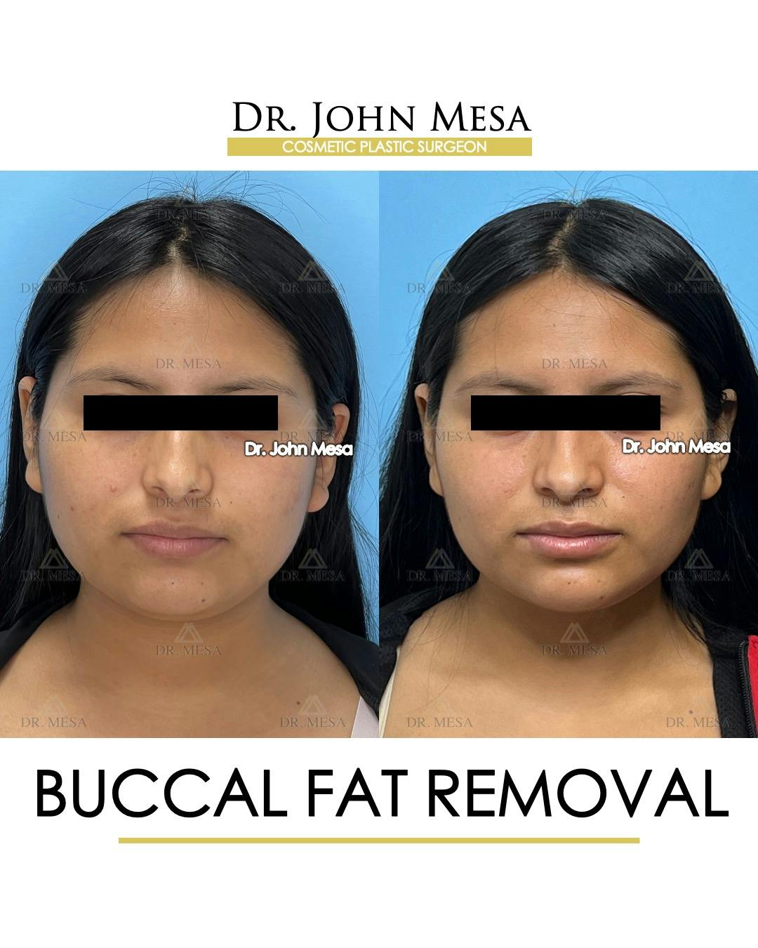 Buccal Fat Pad Removal Before & After Gallery - Patient 356525 - Image 1