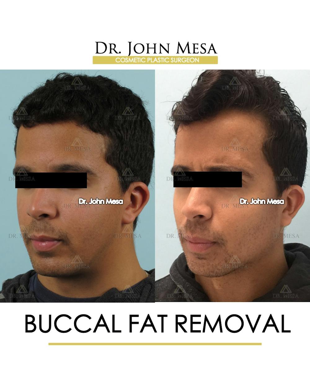 Buccal Fat Pad Removal for Men Before & After Gallery - Patient 239585 - Image 2