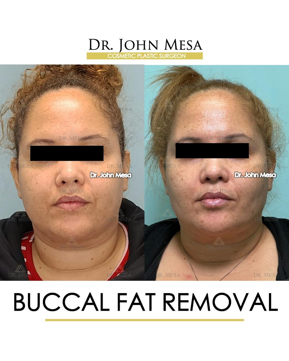 Buccal Fat Pad Removal Before & After Gallery - Patient 393589 - Image 1