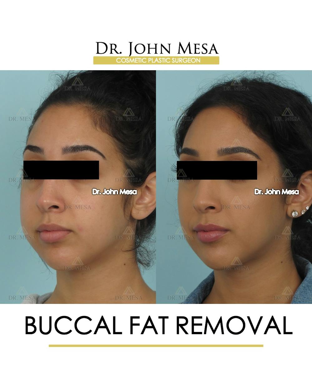 Buccal Fat Pad Removal Before & After Gallery - Patient 528817 - Image 3