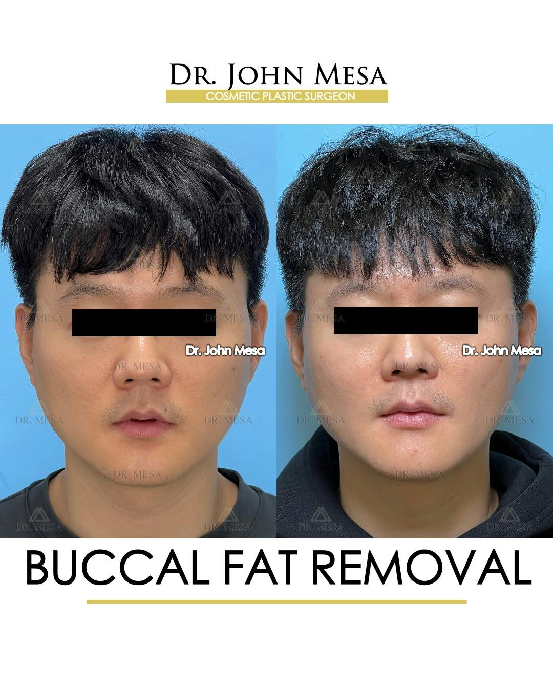 Buccal Fat Pad Removal for Men Before & After Gallery - Patient 401938 - Image 1