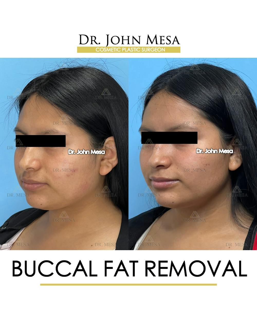 Buccal Fat Pad Removal Before & After Gallery - Patient 356525 - Image 4