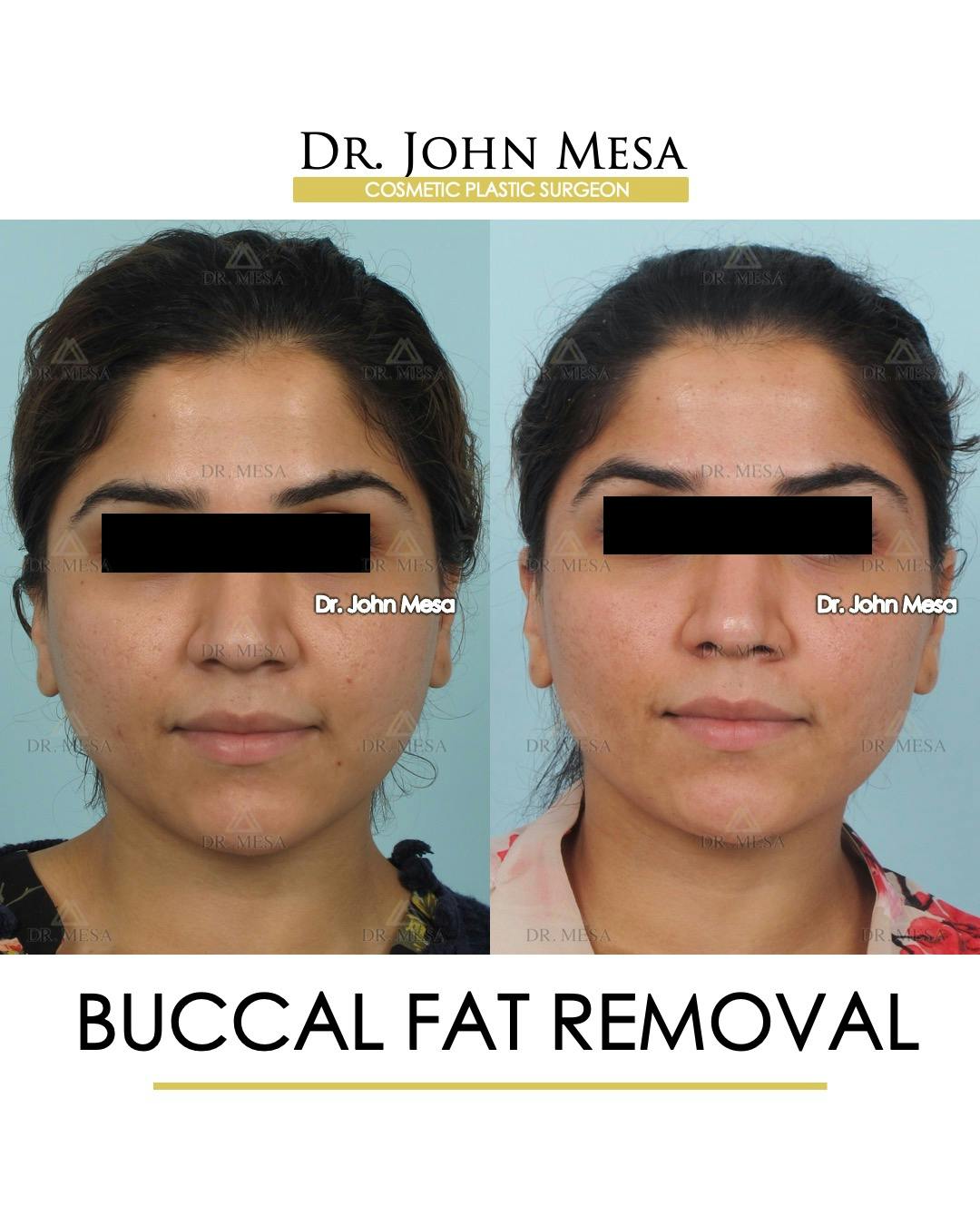 Buccal Fat Pad Removal Before & After Gallery - Patient 308898 - Image 1