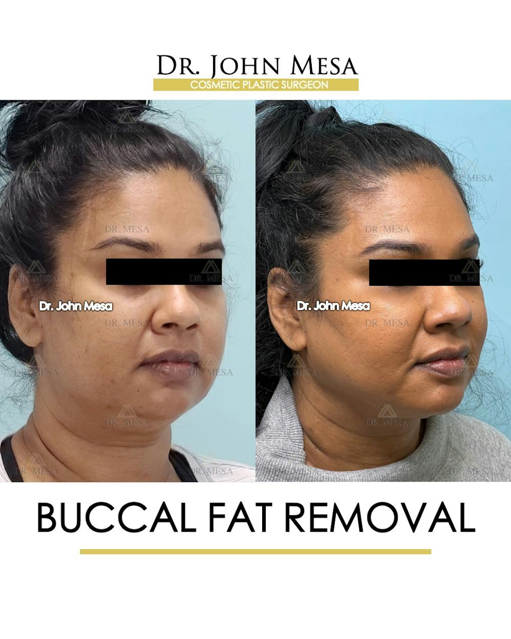 Buccal Fat Pad Removal Before & After Gallery - Patient 142715 - Image 2