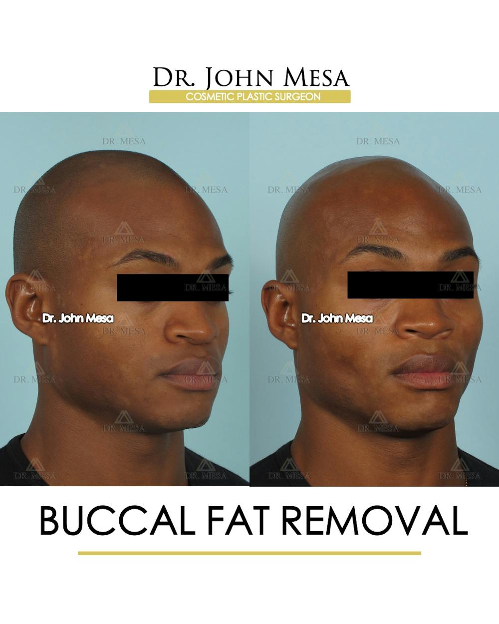 Buccal Fat Pad Removal for Men Before & After Gallery - Patient 807049 - Image 2