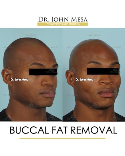 Buccal Fat Pad Removal for Men Before & After Gallery - Patient 807049 - Image 2