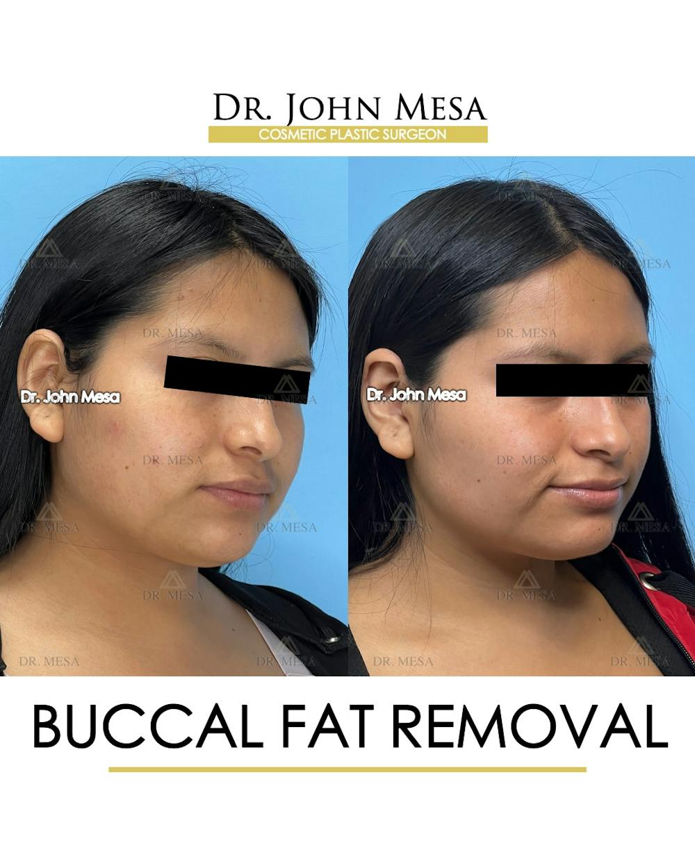 Buccal Fat Pad Removal Before & After Gallery - Patient 356525 - Image 3