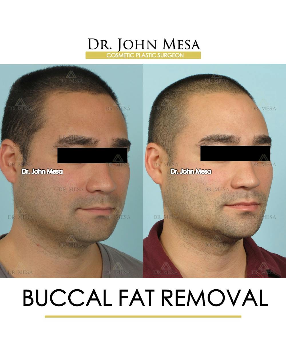 Buccal Fat Pad Removal for Men Before & After Gallery - Patient 168195 - Image 2