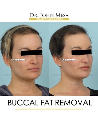 Buccal Fat Pad Removal Before & After Gallery - Patient 224881 - Image 2