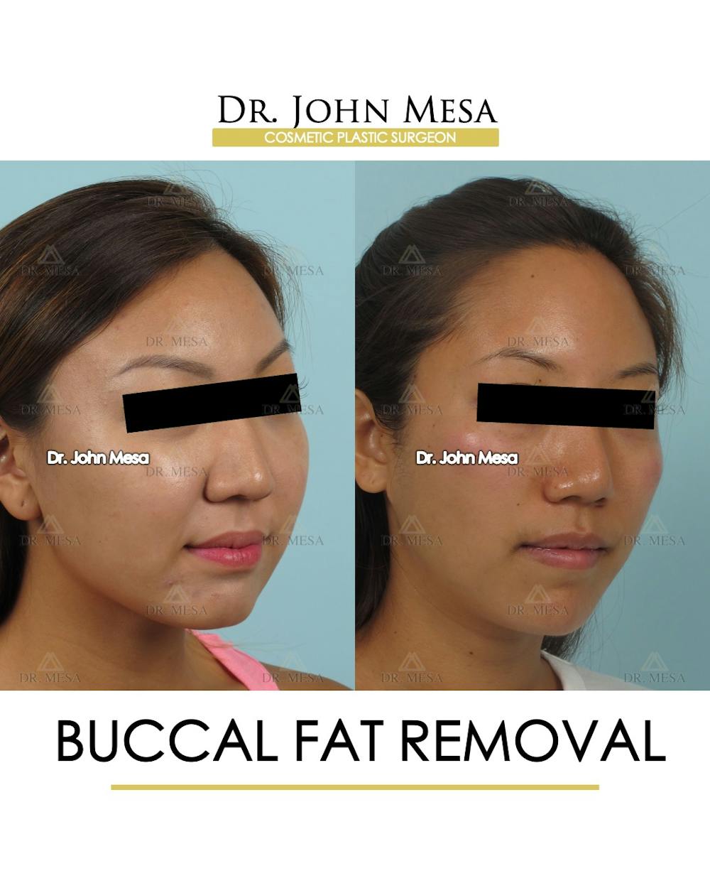 Buccal Fat Pad Removal Before & After Gallery - Patient 339169 - Image 2