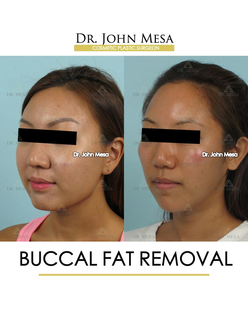 Buccal Fat Pad Removal Before & After Gallery - Patient 339169 - Image 3