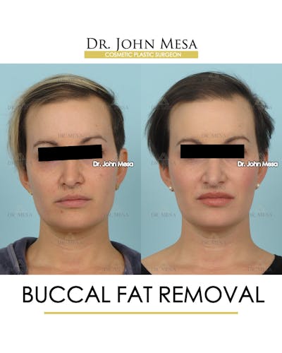 Buccal Fat Pad Removal Before & After Gallery - Patient 224881 - Image 1
