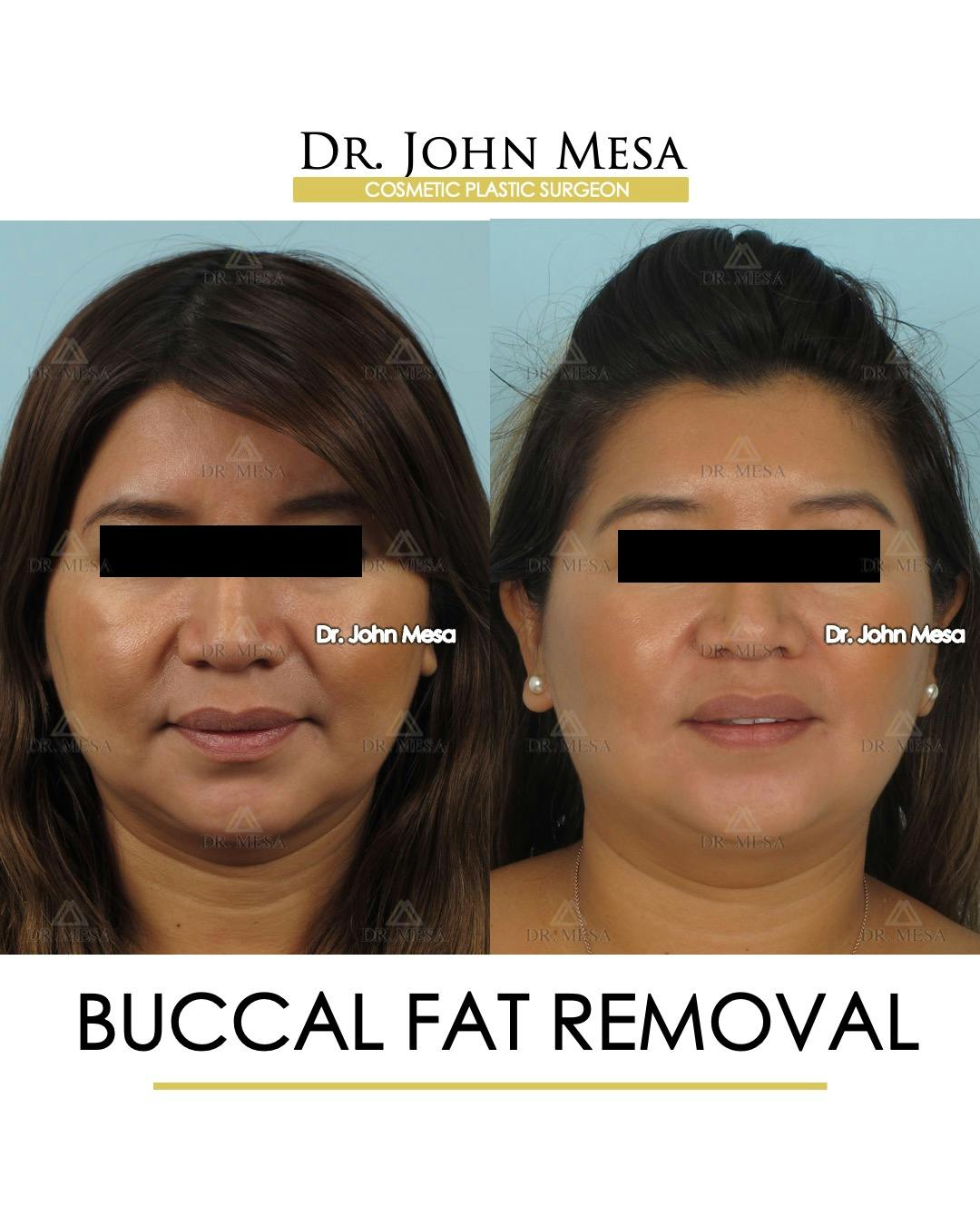 Buccal Fat Pad Removal Before & After Gallery - Patient 206282 - Image 1